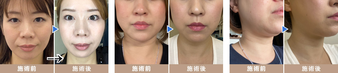 毛穴、ほうれい線が目立たなくなり若々しい印象